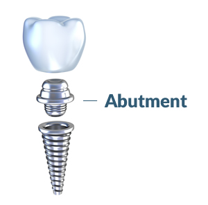 Abutment -element of the dental implant