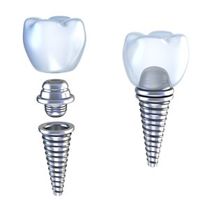 Elements of the dental implant