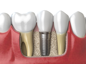 View of the jaw section with a dental implant