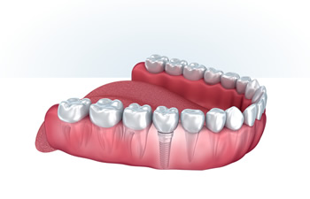 Oral model with a dental implant