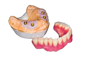 Snap-on dentures
