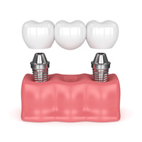 Dental Implant Bridges