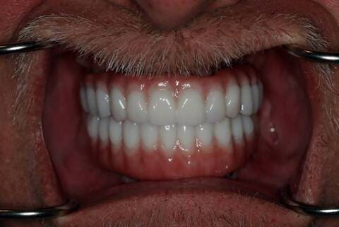 male patient after all on 4 dental implants procedure