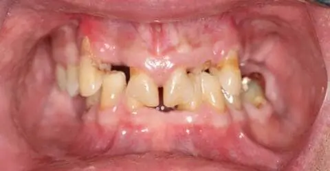 male patient before all on 4 dental implants procedure