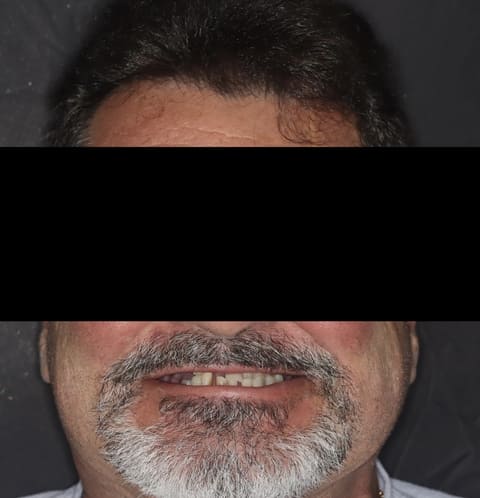 male patient before all on 4 dental implants procedure