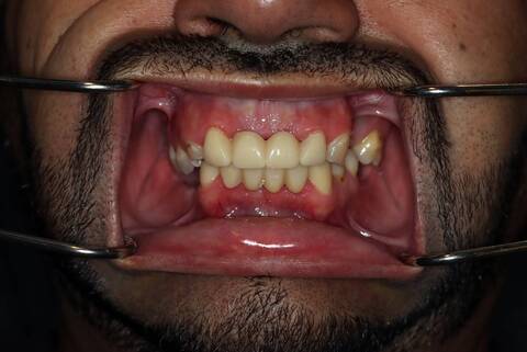 male patient before all on 4 dental implants procedure