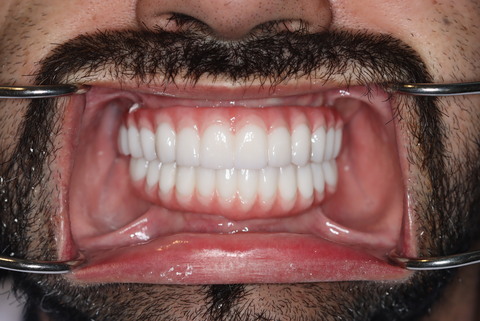 male patient after all on 4 dental implants procedure