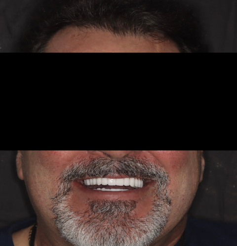 male patient after all on 4 dental implants procedure