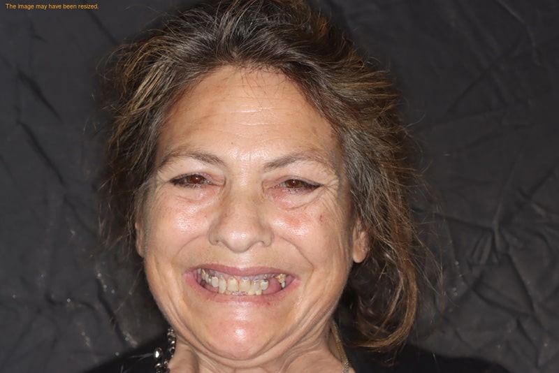 famale patient before all on 4 dental implants procedure
