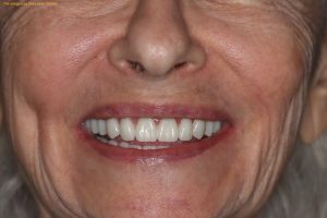 famale patient after all on 4 dental implants procedure