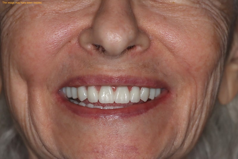 famale patient after all on 4 dental implants procedure