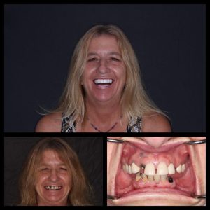famale patient after&before all on 4 dental implants procedure