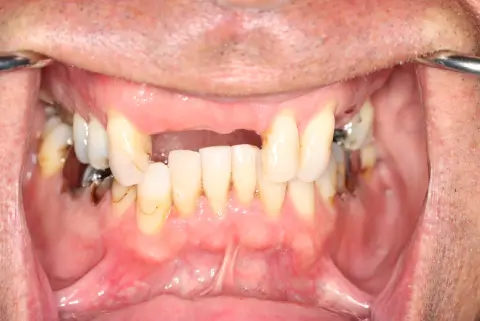 male patient before all on 4 dental implants procedure