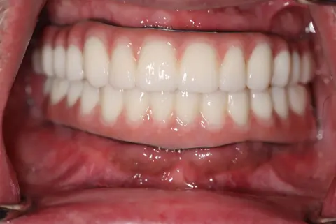 male patient after all on 4 dental implants procedure