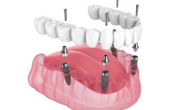 All-on4 Dental Implants