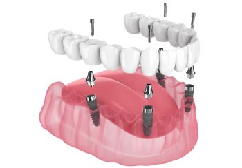 All-on4 Dental Implants