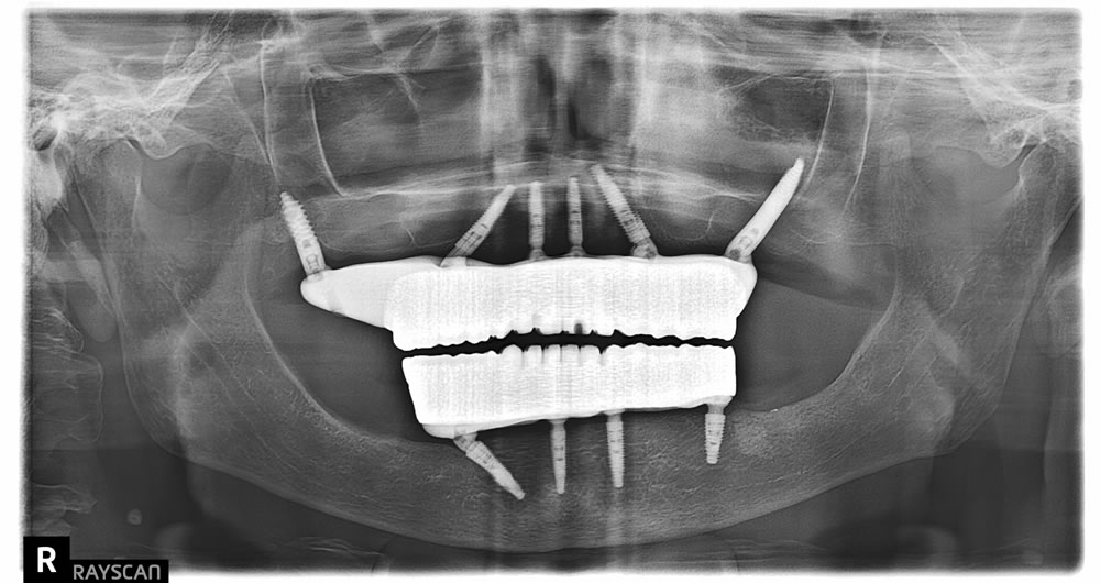 female patient after all on 4 dental implants procedure